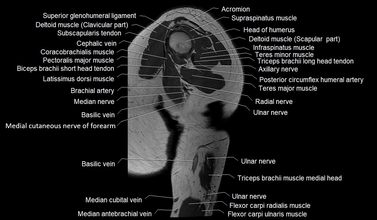 Upper arm (humerus ) saittal cross sectional anatomy 3T image 24.webp